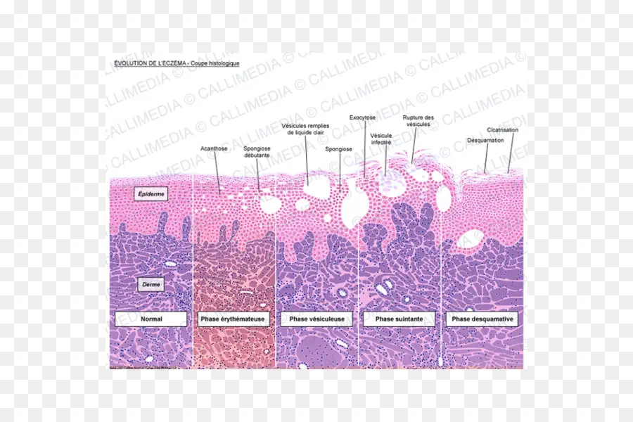 Desarrollo Del Eccema，Piel PNG