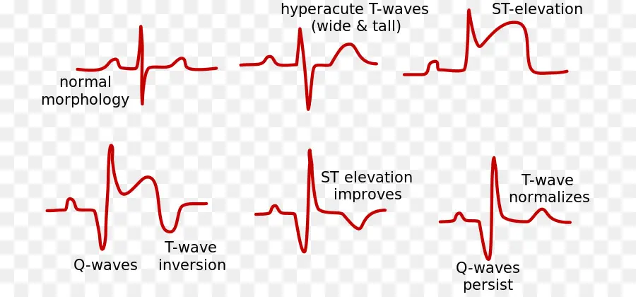 Elevación Del St，El Infarto Agudo De Miocardio PNG