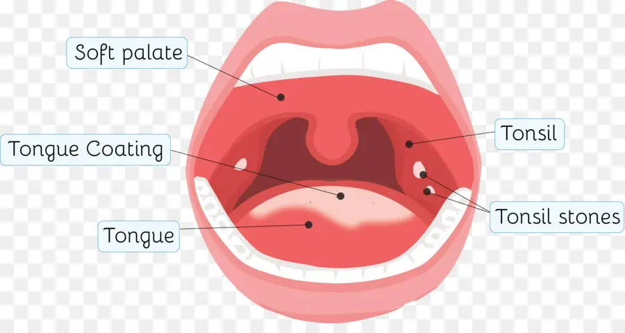 La Infección De Las Amígdalas，Tonsillolith PNG