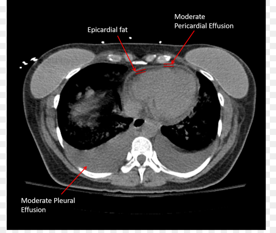 La Tomografía Computada，Derrame Pericárdico PNG