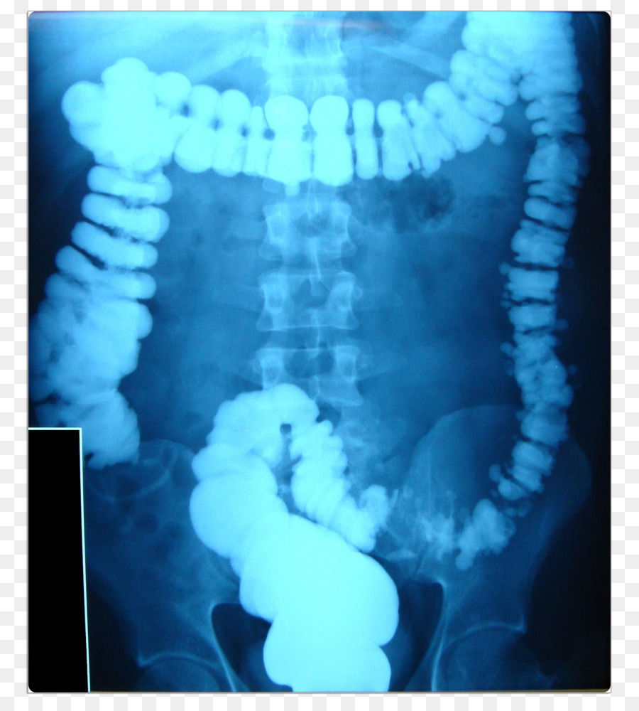 Gastrointestinal Inferior De La Serie，Colon PNG