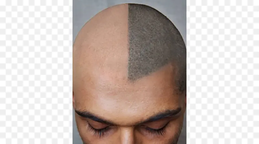 El Pelo Del Tatuaje，La Pérdida De Cabello PNG