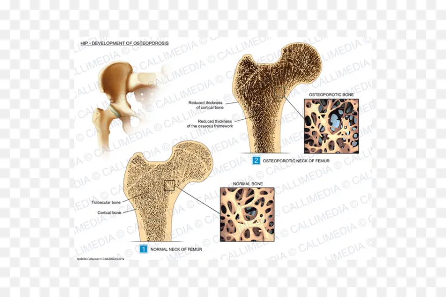 De La Cadera，La Osteoporosis PNG