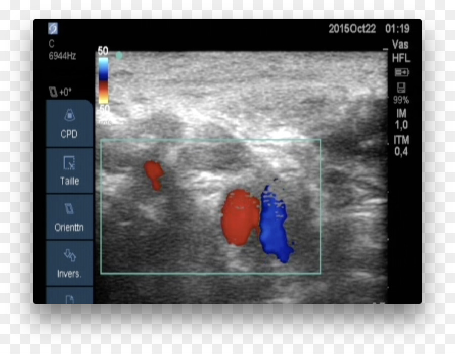 Laboratorio Médico Del Centro De Diagnóstico Federal，Ecocardiografía De Doppler PNG