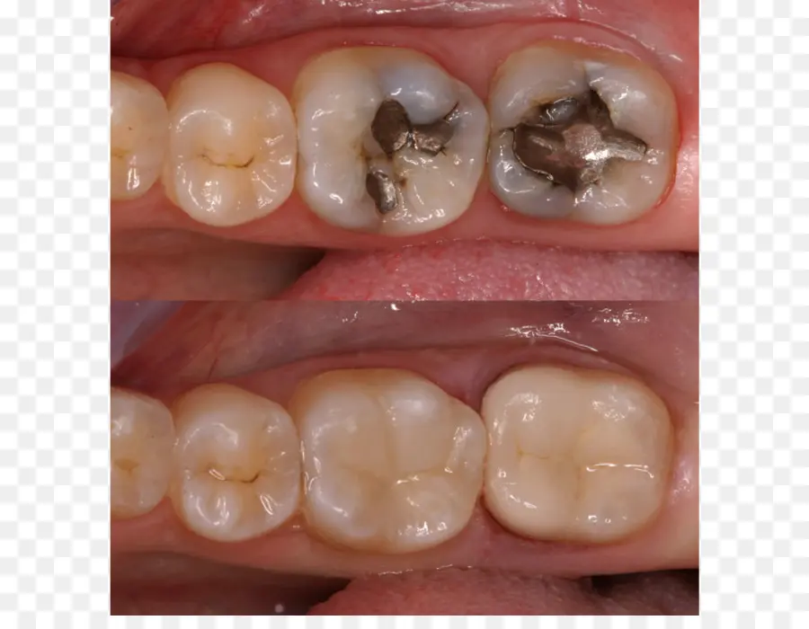 Dientes，Dental PNG