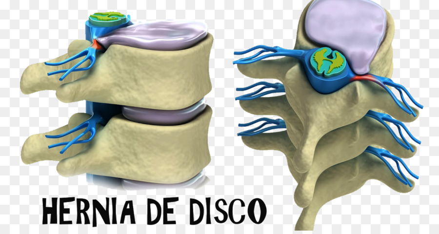 Espinal Hernia De Disco，La Columna Vertebral PNG