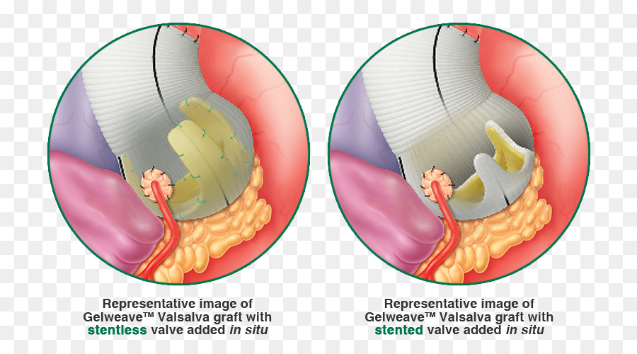 Procedimiento De Bentall，La Maniobra De Valsalva PNG