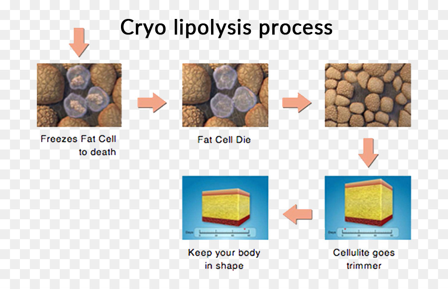 Cryolipolysis，La Liposucción PNG