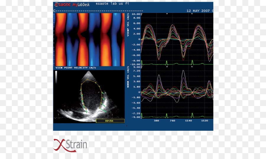 Cardiología，Enfermedad Cardiovascular PNG