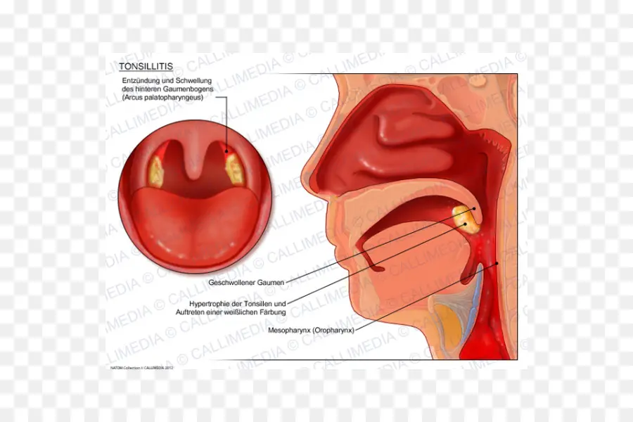 La Amigdalitis，La Infección De Las Amígdalas PNG