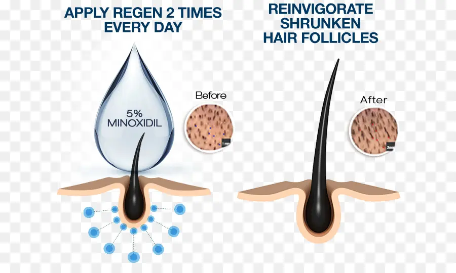 Tratamiento Capilar Con Minoxidil，Rebrote PNG