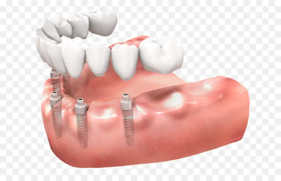 Diente，Prótesis Dentales PNG