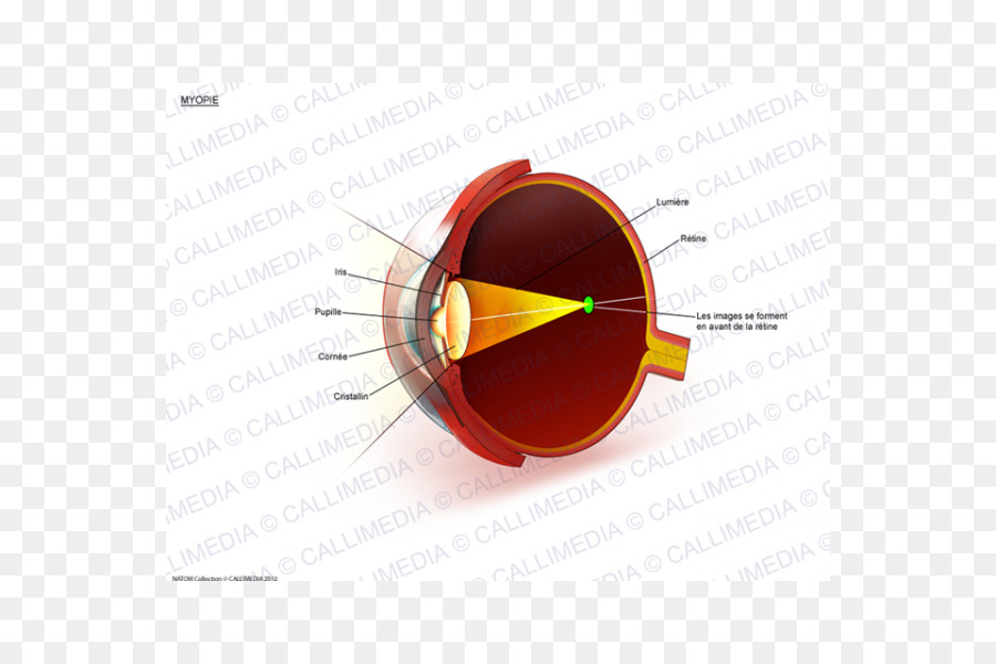 La Hipermetropía，Oftalmología PNG