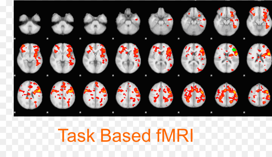 Imágenes De Resonancia Magnética Funcional，Imágenes De Resonancia Magnética PNG