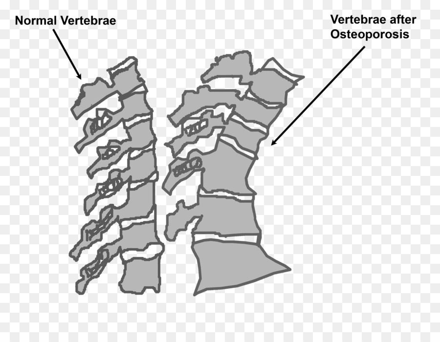 Osteoporosis，La Columna Vertebral PNG