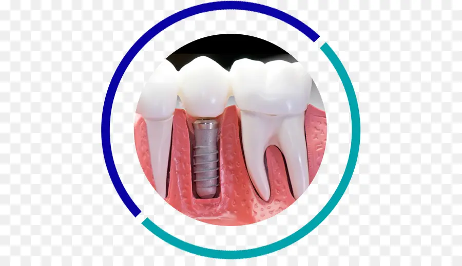 Implante Dental，Odontología PNG