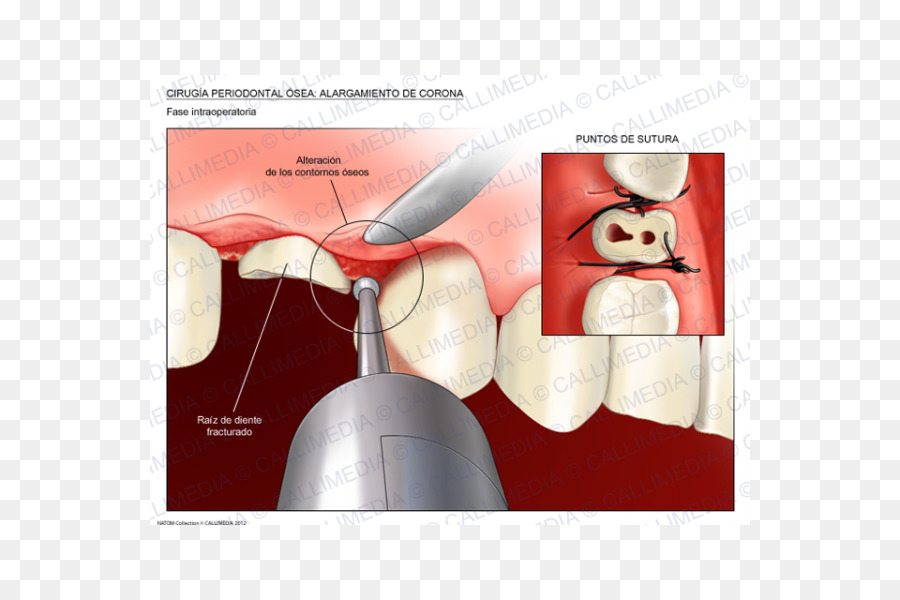 Alargamiento De La Corona，Cirugía PNG