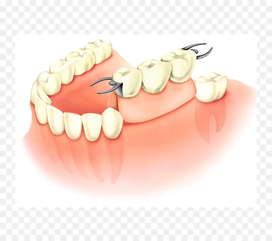 Diente，Dentadura Postiza PNG