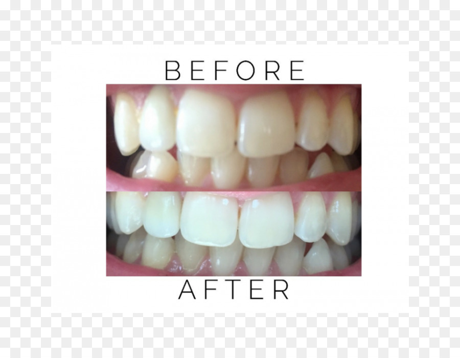 Blanqueamiento Dental，Dental PNG