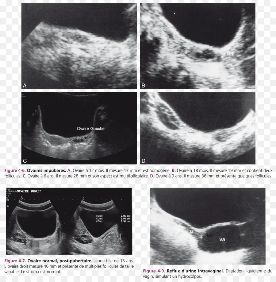 Ovario，Ultrasonografía Ginecológica PNG