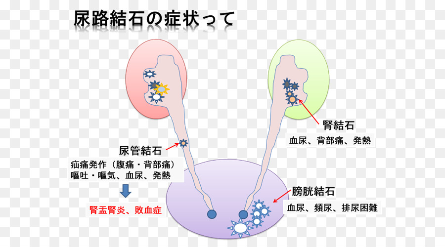 Piedra En El Riñón，Calculo PNG