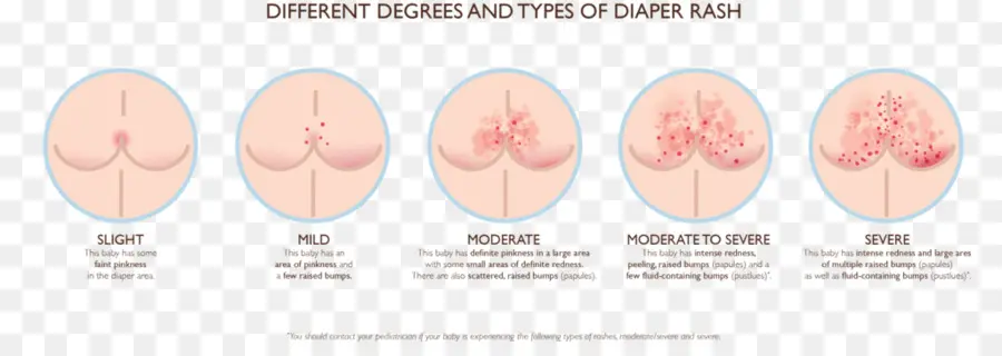 Dermatitis Del Pañal，Grados PNG