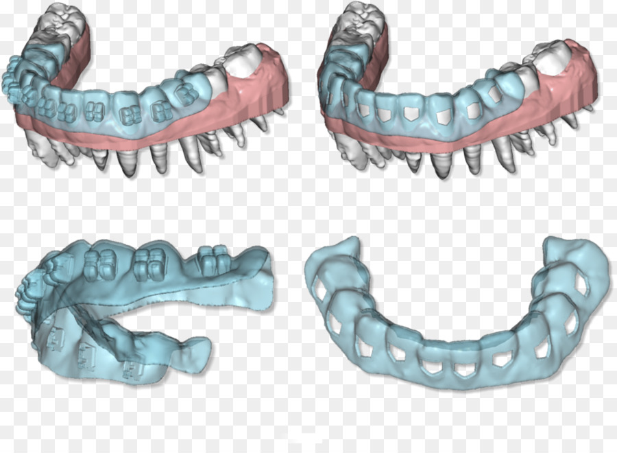 Implantes Dentales，Dientes PNG