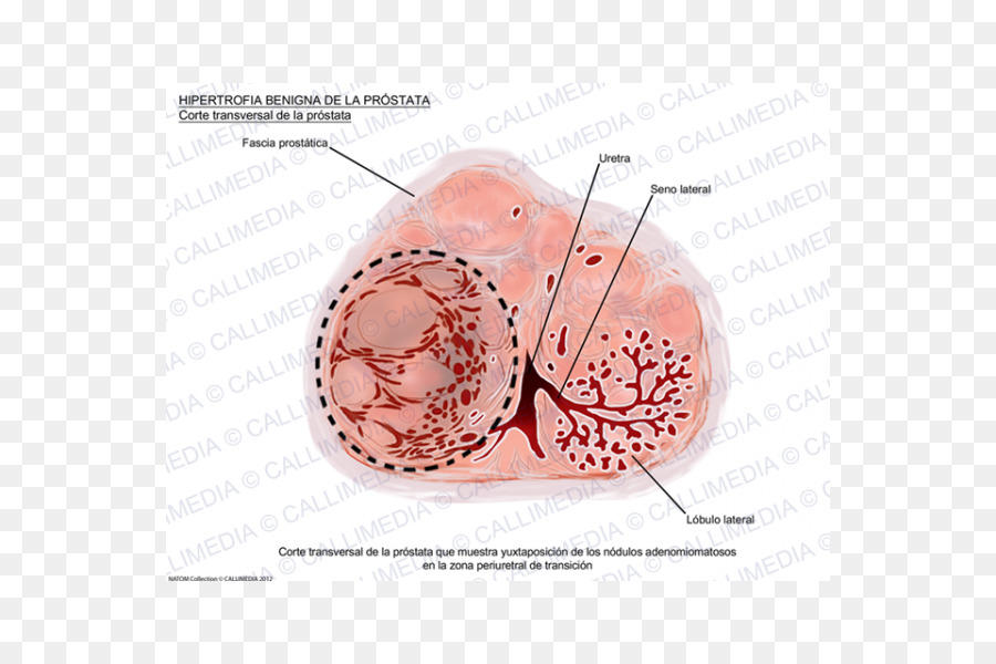 Hiperplasia Prostática Benigna，Próstata PNG