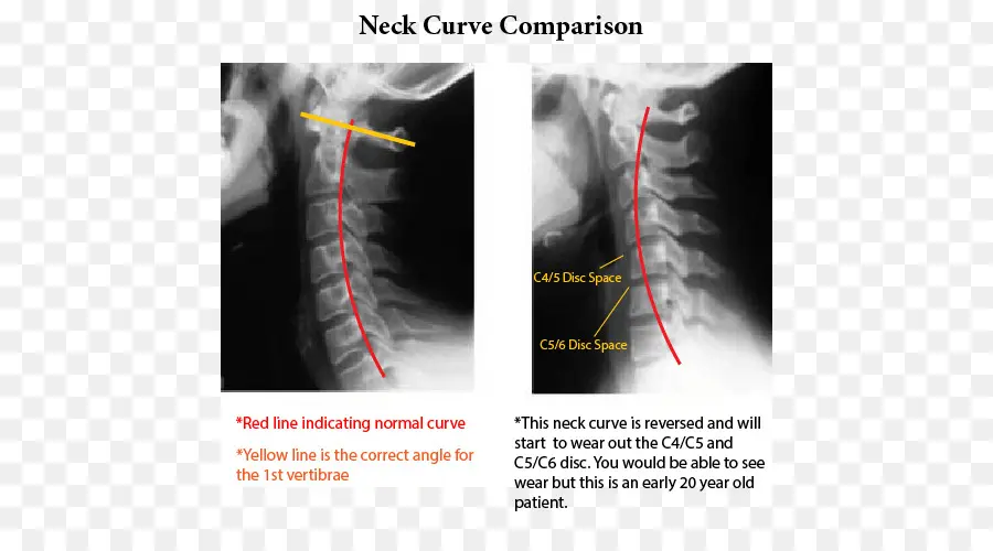 El Dolor De Cuello，El Latigazo Cervical PNG