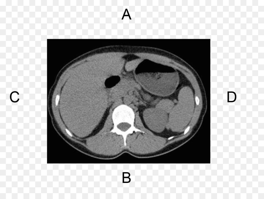 La Tomografía Computada，ósea PNG