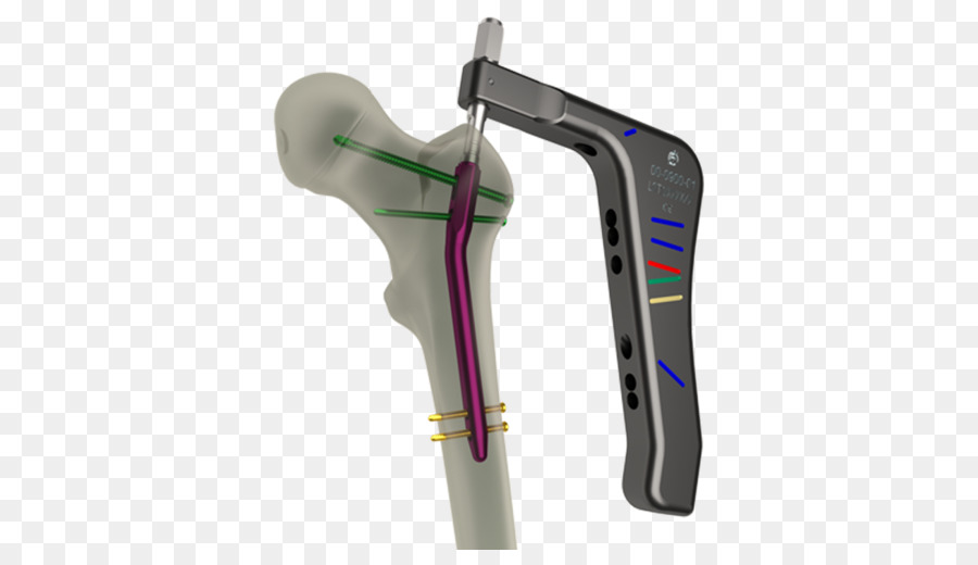 Fémur，Varilla Intramedular PNG