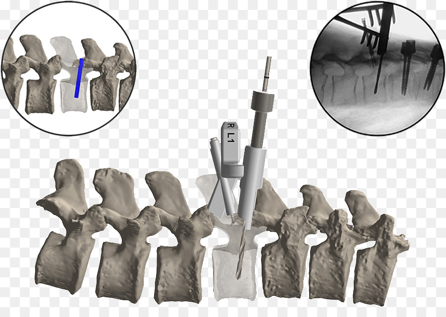 La Columna Vertebral，Fusión Espinal PNG