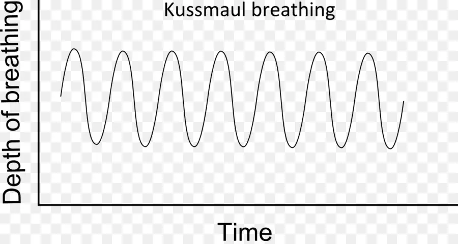 La Respiración De Kussmaul，El Signo De Kussmaul PNG