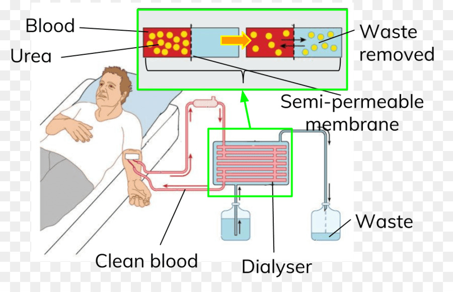 Proceso De Diálisis，Sangre PNG