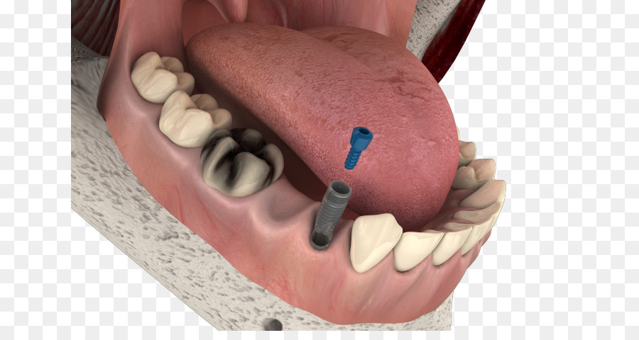 Implante Dental，Implante PNG