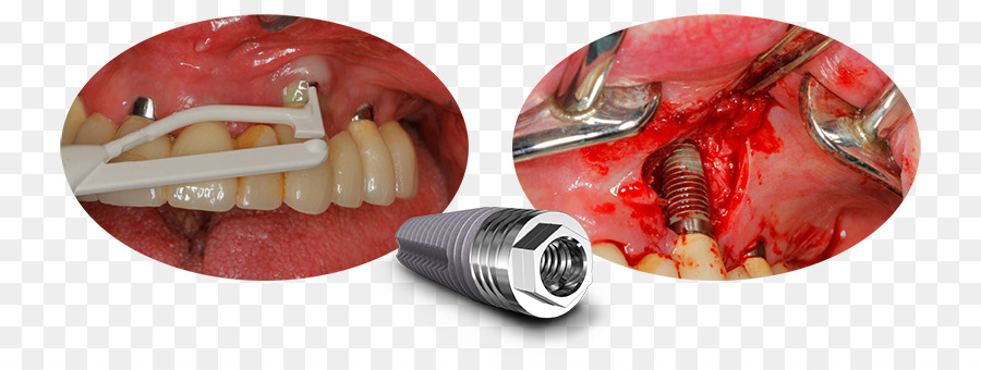 Periimplantitis，Riesgo PNG