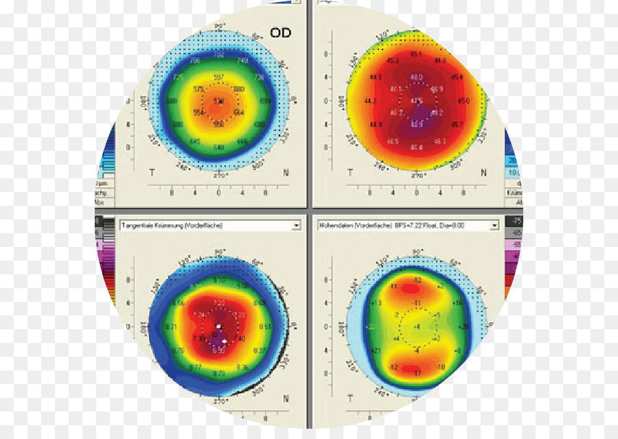 Catarata，Topografía Corneal PNG