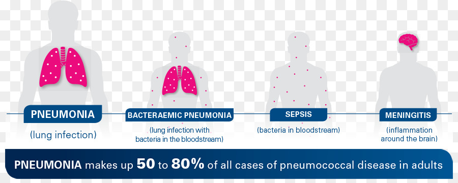 Infografía Sobre Neumonía，Neumonía PNG