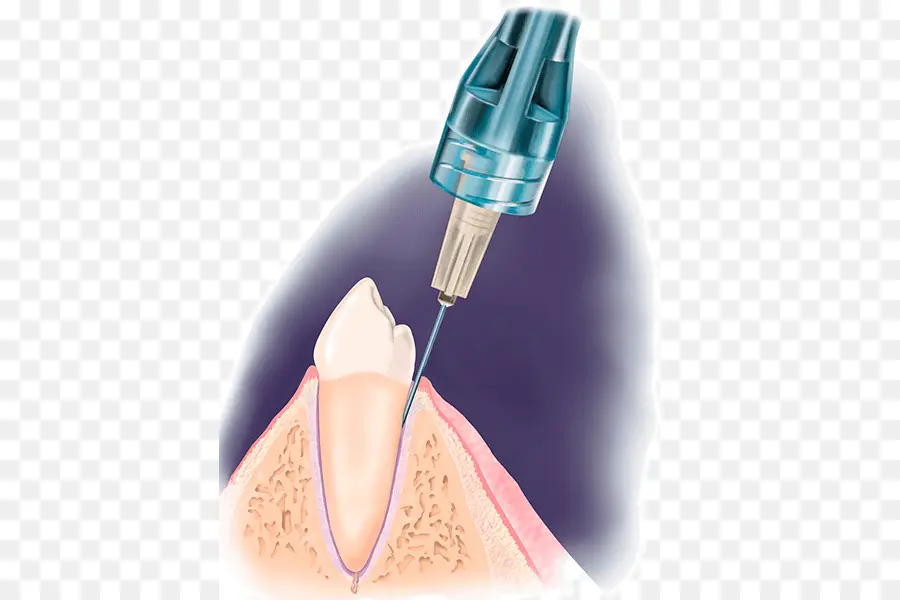 Odontología，Anestesia Local PNG