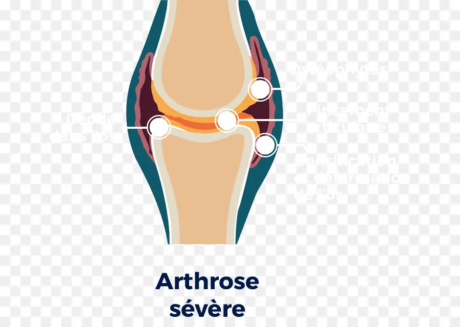 Osteoartritis，Rodilla PNG