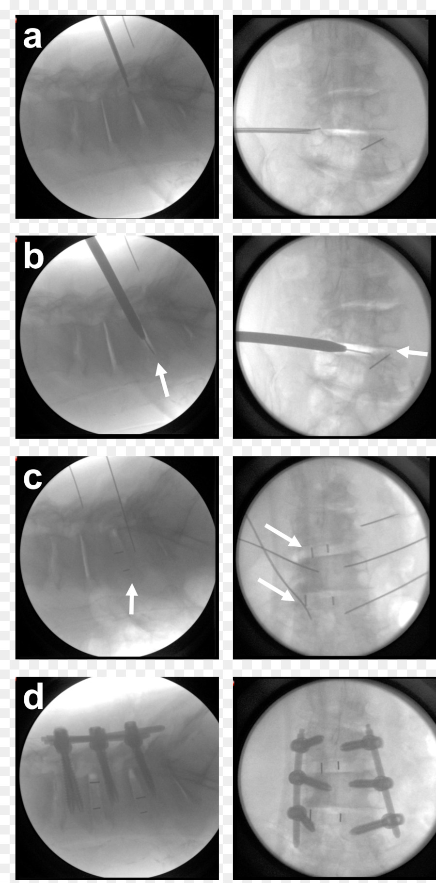 Vértebra Lumbar，Fusión Espinal PNG