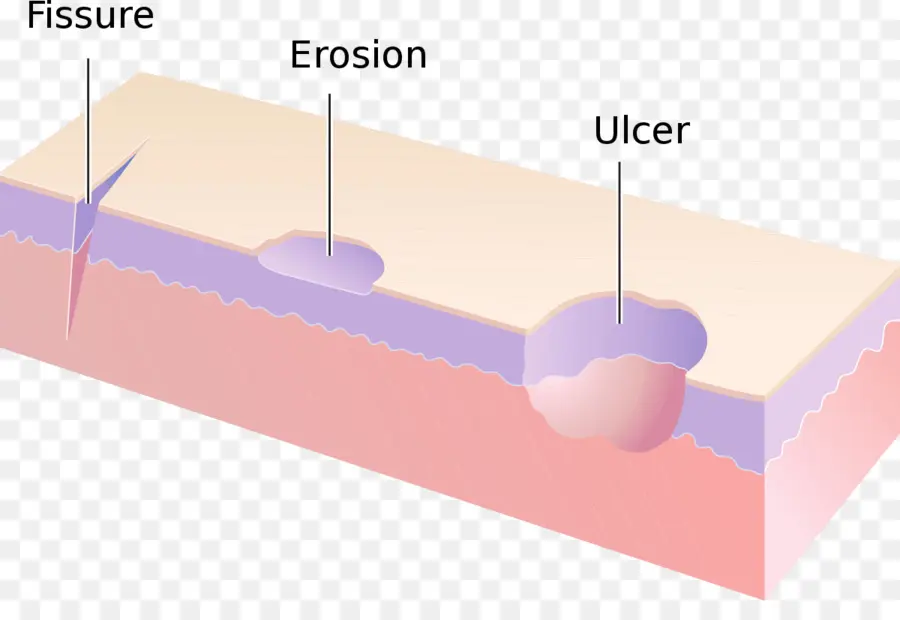 Erosión，Dermatología PNG