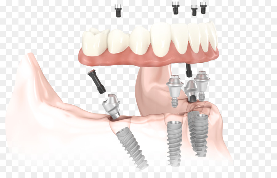 Allon4，Implante Dental PNG