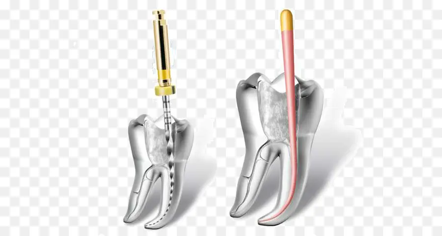 Endodoncia，El Canal De La Raíz PNG