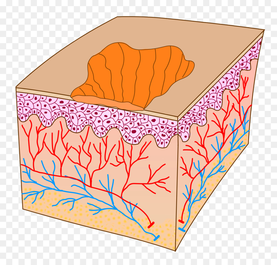 Los Lípidos，Xantoma PNG