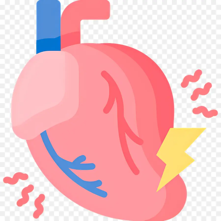 Infarto De Miocardio，Corazón PNG