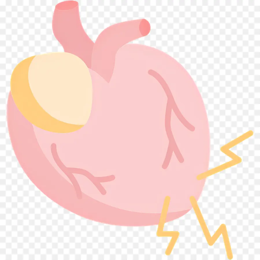 Infarto De Miocardio，Corazón Con Relámpago PNG